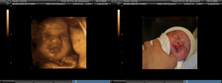 Elianna in utero and just out
